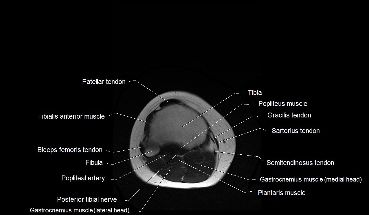 MRI thigh cross sectional anatomy image 62.webp